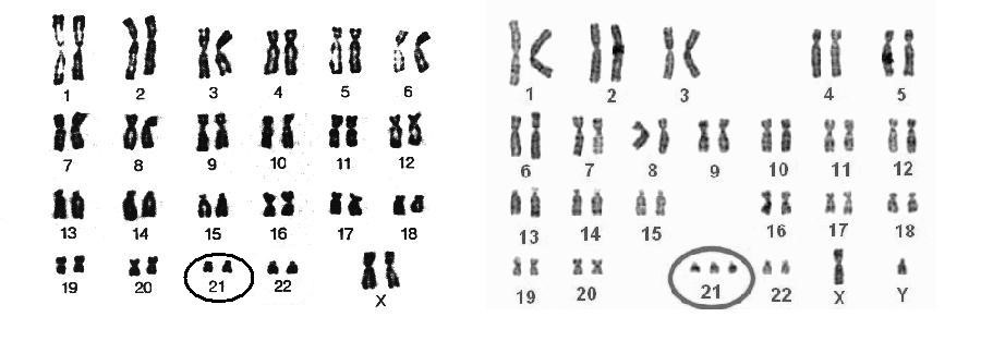 Cariotipo normal y cariotipo defectuoso