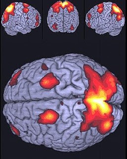 Se observa una gran intensidad en el lóbulo parietal superior